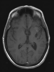 MRI-scan oktober 2009